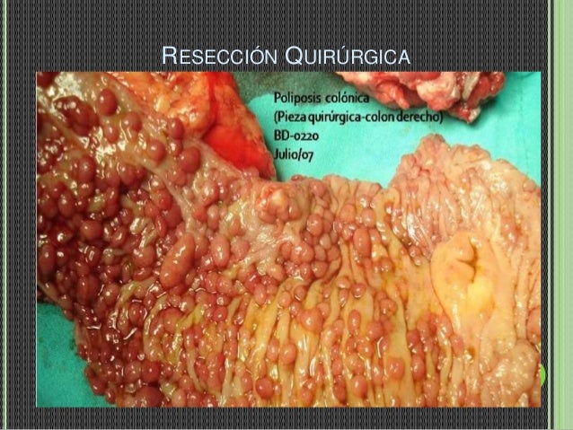 poliposis intestinal
